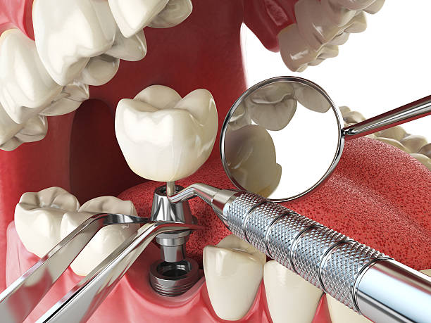 Best Emergency Dentist for Lost Fillings or Crowns in Carencro, LA